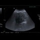 Cholangiocellular carcinoma of liver, dilation of intrahepatic ducts: US - Ultrasound